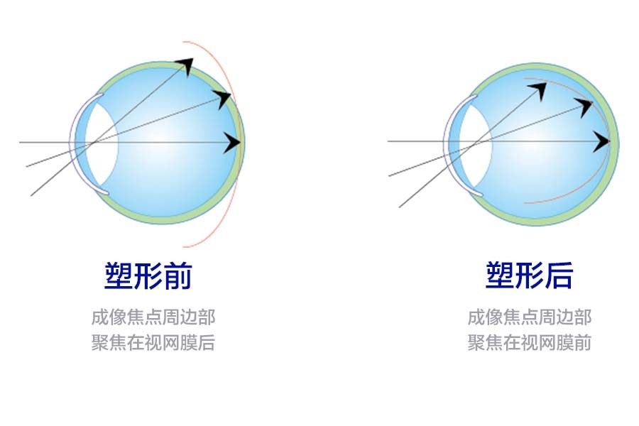 角膜塑形鏡OK不OK？福州銳明愛爾眼科專家來解答