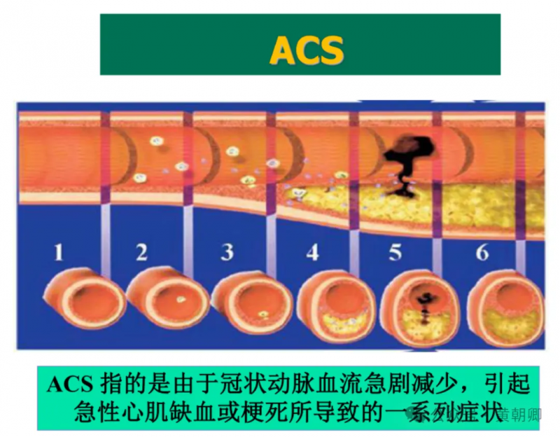 心梗猝死常突發，步長青花瓷腦心通膠囊穩定斑塊“可救命”--研究證實